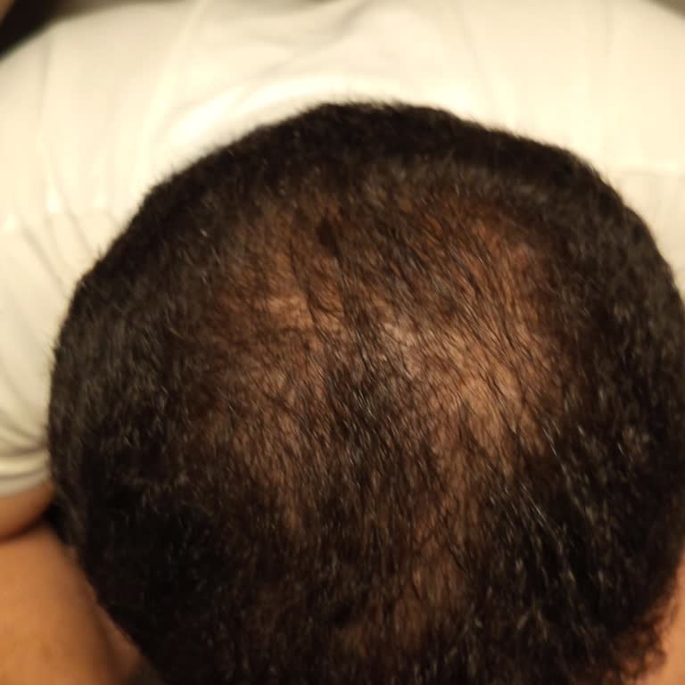 Eksik Seans Ve Olumsuz Sonuç Nedeniyle İade Talebi