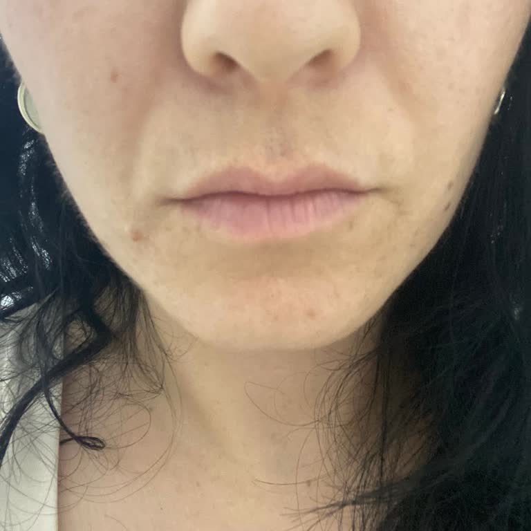 Dolgu İşlemi Sonrası Ek Ücret Talebi Ve Sonuçsuz Uygulama