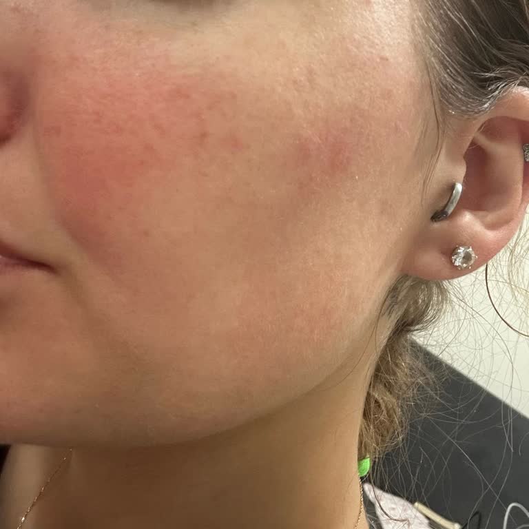 Bioderma Atoderm Cream Cildimde Ciddi Alerjik Reaksiyona Yol Açtı