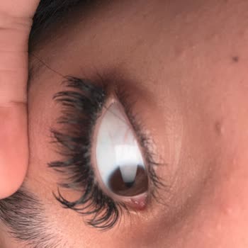 Güzellik Merkezi Kirpik Uygulaması Sonrası Yaşanan Sorun