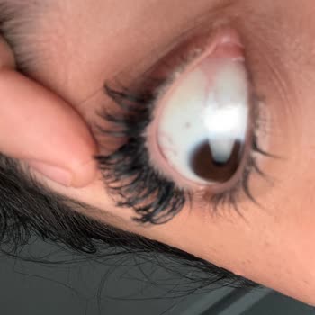 Güzellik Merkezi Kirpik Uygulaması Sonrası Yaşanan Sorun