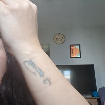 Lazerle Dövme Silme İşleminde Sonuçsuzluk Ve İlgisiz Yaklaşım