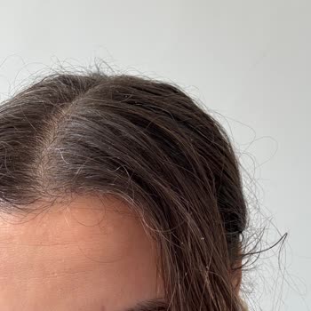 Bioblas Şampuan Saç Dökülmesini Azaltmadı, Kaşıntı Ve Kepek Yaptı