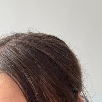 Bioblas Şampuan Saç Dökülmesini Azaltmadı, Kaşıntı Ve Kepek Yaptı