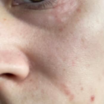 Yves Rocher Göz Ve Gündüz Kremi Cildimde Alerjiye Ve Morluklara Yol Açtı, İade İstiyorum