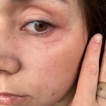 Yves Rocher Göz Ve Gündüz Kremi Cildimde Alerjiye Ve Morluklara Yol Açtı, İade İstiyorum