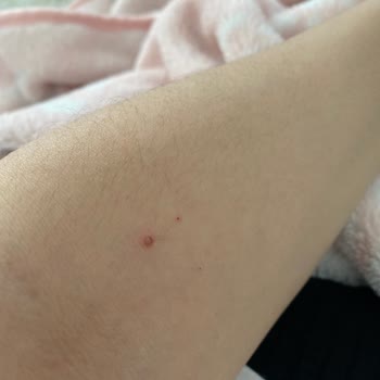 Velavit Probiyotik Kullanımı Sonrası Sağlık Sorunları Ve İade Talebim