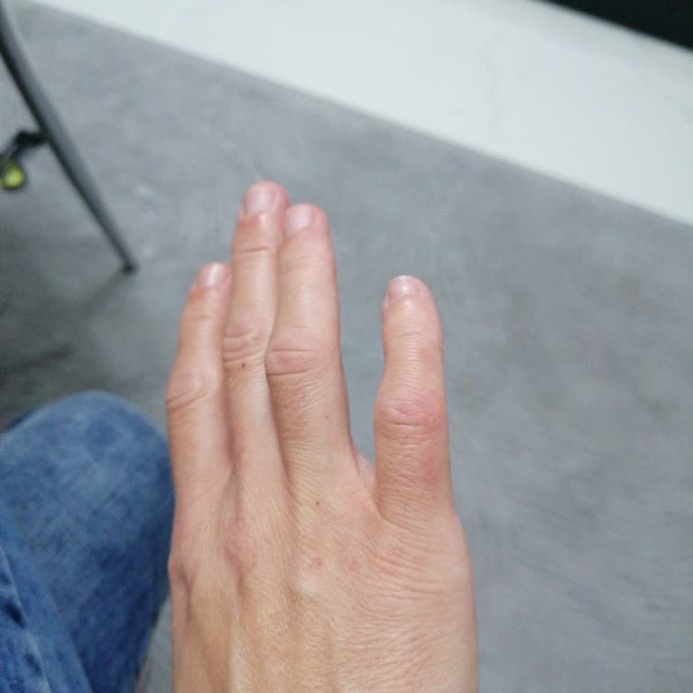 Lezita Çıtır Kova Ürünü Patladı: Yanık Ve Güvenlik Endişesi Yaşadım