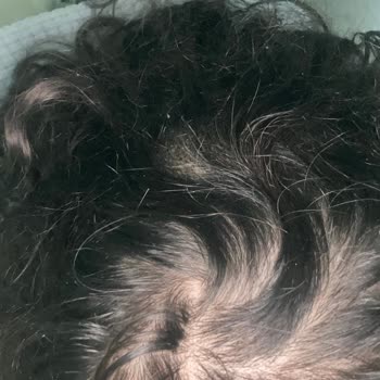 Saç Ekimi Sonrası Boşluklar Ve Yetersiz İletişim Nedeniyle Mağduriyet