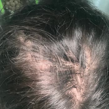 Saç Ekimi Sonrası Boşluklar Ve Yetersiz İletişim Nedeniyle Mağduriyet