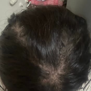 Saç Ekimi Sonrası Boşluklar Ve Yetersiz İletişim Nedeniyle Mağduriyet