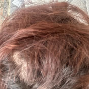 Saç Ekimi Sonrası Boşluklar Ve Yetersiz İletişim Nedeniyle Mağduriyet