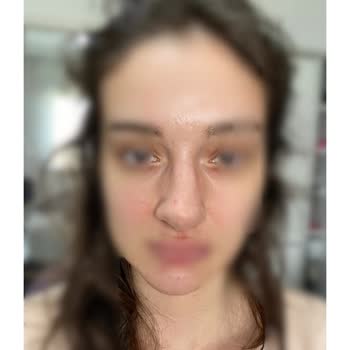 Ameliyat Sonrası Mağduriyet Ve Sorumluluk Reddiyle Travmatik Bir Deneyim