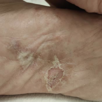 Lacoste Ayakkabı Kaynaklı Sağlık Sorunu Ve Masraf Talebi