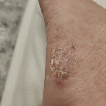 Lacoste Ayakkabı Kaynaklı Sağlık Sorunu Ve Masraf Talebi