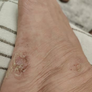 Lacoste Ayakkabı Kaynaklı Sağlık Sorunu Ve Masraf Talebi