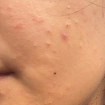 Bioderma Sebium Yüz Yıkama Jeli Sonrası Cilt Sorunu Ve İade Talebi