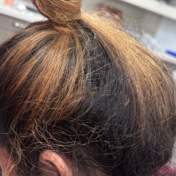 Saçlarım Yandı, Mağduriyetim Giderilmedi!