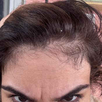 Saçlarım Yandı, Mağduriyetim Giderilmedi!