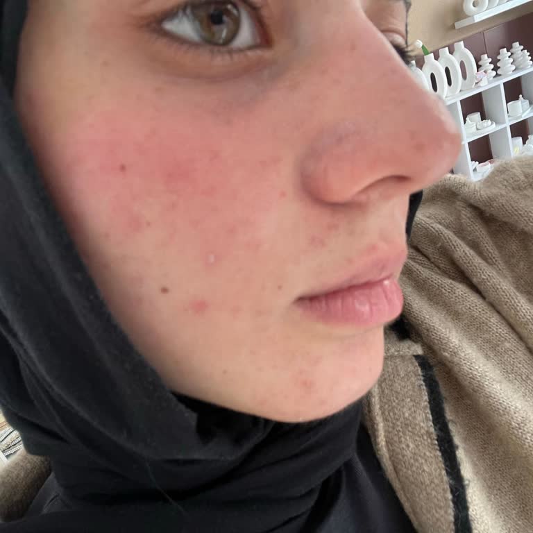 Tester Güneş Kremi Yüzümde Yanık Oluşturdu, Tazminat Talep Ediyorum