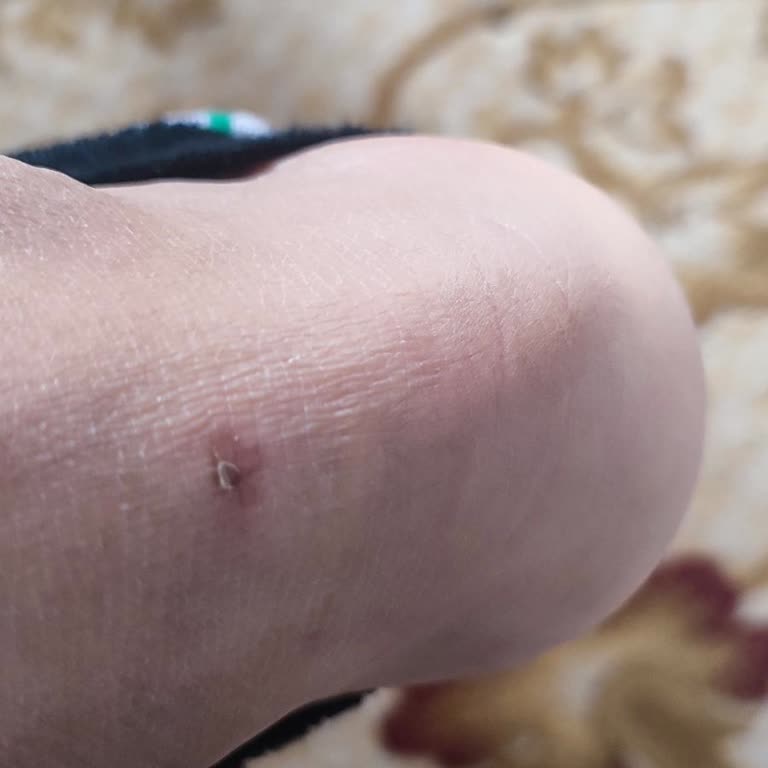 İlk Kullanımda Yaraya Sebep Olan Ayakkabı İçin FLO'dan Çözüm Bekliyorum