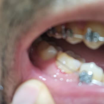 Kuruyemiş Barın İçinden Çıkan Sert Kabuk Diş Teli Braketimi Kopardı