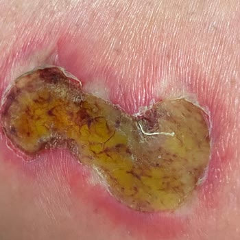 Zenora Vip Güzellik Merkezi'nde Yanık Ve Yetkisiz Personel Nedeniyle Mağduriyet