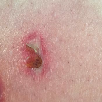 Zenora Vip Güzellik Merkezi'nde Yanık Ve Yetkisiz Personel Nedeniyle Mağduriyet