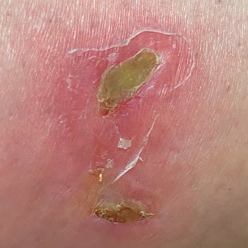 Zenora Vip Güzellik Merkezi'nde Yanık Ve Yetkisiz Personel Nedeniyle Mağduriyet