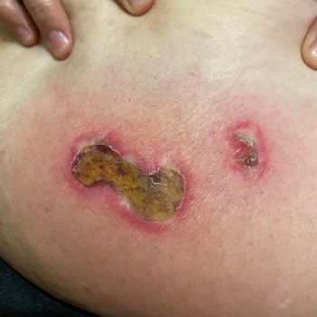 Zenora Vip Güzellik Merkezi'nde Yanık Ve Yetkisiz Personel Nedeniyle Mağduriyet