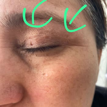 Aktif International Hospital Göz Kapağı Ameliyatı Sonrası Kalıcı İzler Ve Ağrı İçin Çözüm Sunulmadı