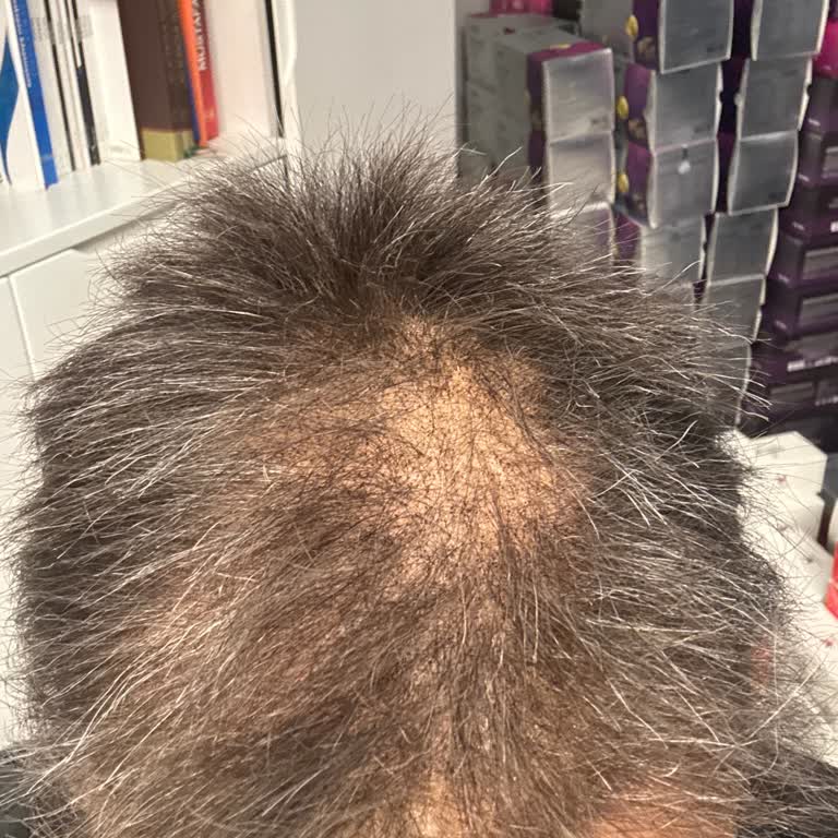 Satın Aldığım Saç Protezinin Kısa Sürede Dökülmesi Ve İlgi Eksikliği Mağduriyet Yarattı