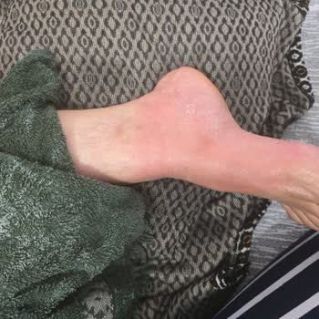 Fakir Çay Makinesi Kulpunun Kopmasıyla Yanık Ve Güvenlik Riski Yaşadım