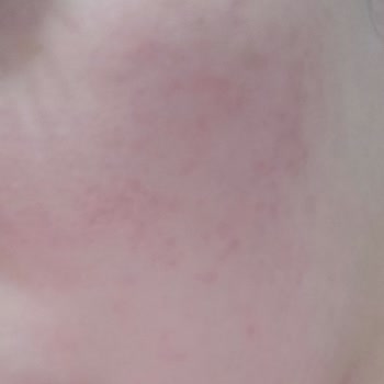 Ciltte Şiddetli Yanma Ve Kızarıklık Yapan Ürün İçin İade Talebi