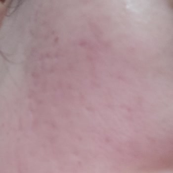 Ciltte Şiddetli Yanma Ve Kızarıklık Yapan Ürün İçin İade Talebi