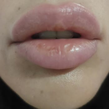 Dudak Dolgusu Sonrası Geçmeyen Kabarcıklar Ve İlgisiz Klinik