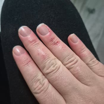 Bitkisel Temizleyici Ellerimde Ciddi Yanma Yaptı Açıklama Bekliyorum