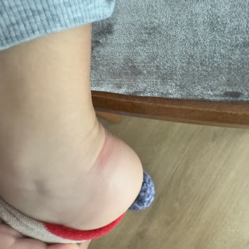 Çocuğumun Ayağını Yaralayan Ayakkabıya Skechers'dan Yetersiz Destek