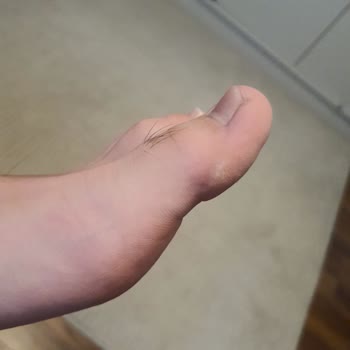 İlk Kullanımda Yaralayan Ayakkabıya İade Engeli