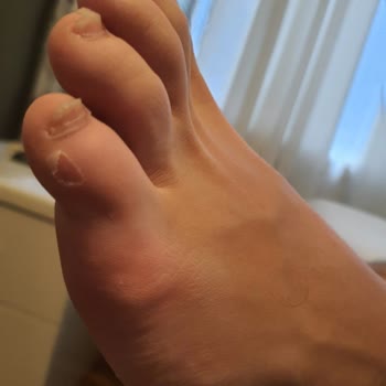 İlk Kullanımda Yaralayan Ayakkabıya İade Engeli