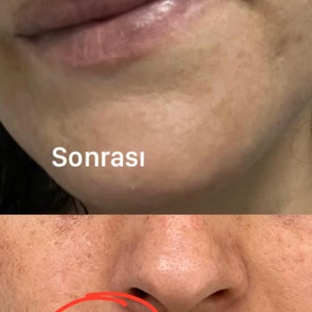 Doç. Dr. Havva Yıldız Seçkin İşlem Sonrası Lazer Yanığı Oluştu