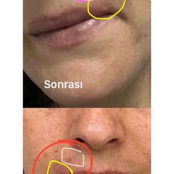 Doç. Dr. Havva Yıldız Seçkin İşlem Sonrası Lazer Yanığı Oluştu