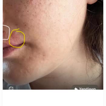 Doç. Dr. Havva Yıldız Seçkin İşlem Sonrası Lazer Yanığı Oluştu