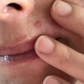 Doç. Dr. Havva Yıldız Seçkin İşlem Sonrası Lazer Yanığı Oluştu