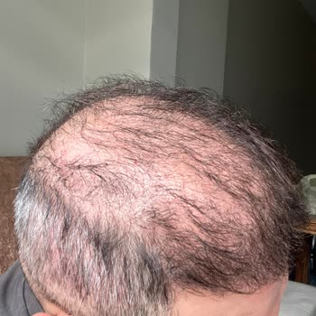 Adem Köse Saç Ekimi Sonrası Olumsuz Sonuç Ve Yanıltıcı Sosyal Medya Faaliyetleri