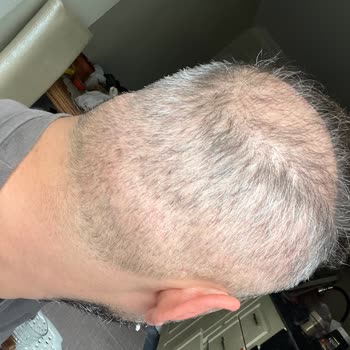 Adem Köse Saç Ekimi Sonrası Olumsuz Sonuç Ve Yanıltıcı Sosyal Medya Faaliyetleri