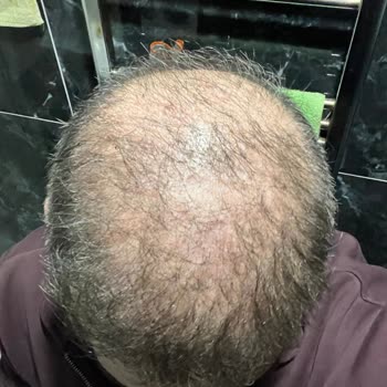 Adem Köse Saç Ekimi Sonrası Olumsuz Sonuç Ve Yanıltıcı Sosyal Medya Faaliyetleri