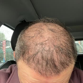 Adem Köse Saç Ekimi Sonrası Olumsuz Sonuç Ve Yanıltıcı Sosyal Medya Faaliyetleri