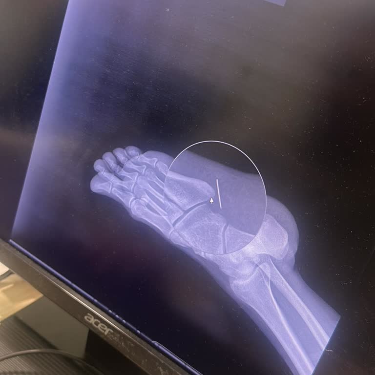 Elbise İçinde Unutulan İğne Nedeniyle Ameliyat Ve Maddi Zarar