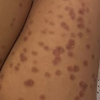 Lazer Epilasyon Sonrası Ciddi Yanıklar Ve Klinikten İlgisizlik